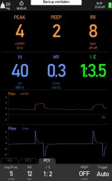 Візуалізація параметрів вентиляції на дисплеї АМ70. Система відображає показники PEAK, PEEP, частоту дихання, дихальний об'єм та хвилинну вентиляцію. Чіткі графіки Paw та Flow дозволяють лікарю контролювати механіку легень пацієнта під час анестезії