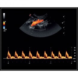 На зображенні показано кольорове картування кровотоку всередині судини. У нижній частині екрана видно графік спектрального доплера для аналізу швидкості та характеру кровотоку